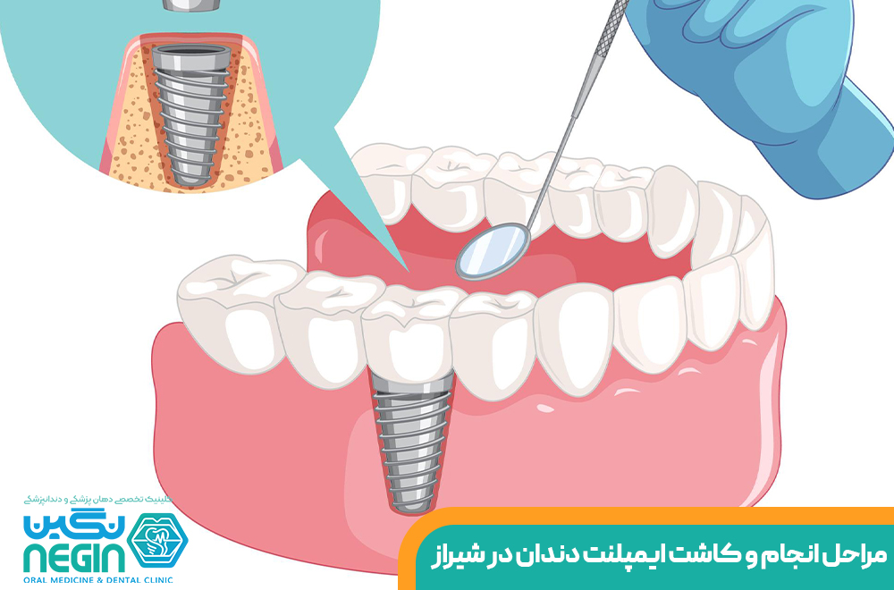 کاشت ایمپلنت دندان در شیراز چقدر طول می کشد؟